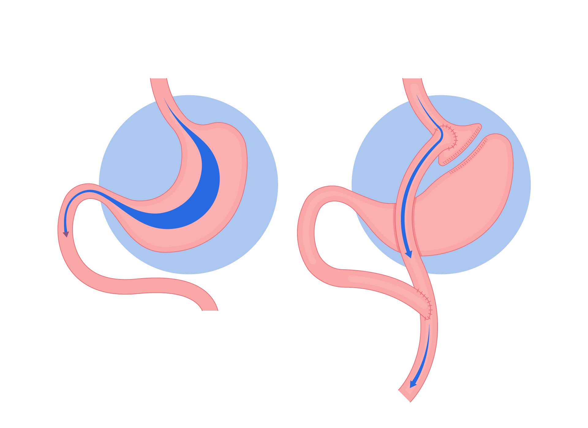 Que es la Cirugia de Bypass Gastrico